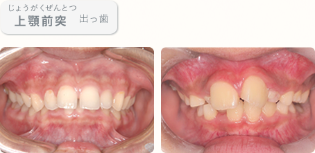 上顎前突(じょうがくぜんとつ)　出っ歯