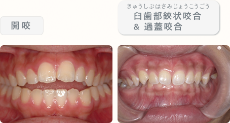 開咬、臼歯部鋏状咬合＆過蓋咬合