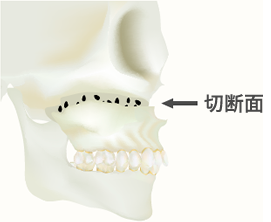 上顎:Le fort I型骨切り術