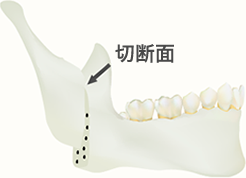 下顎:IVRO