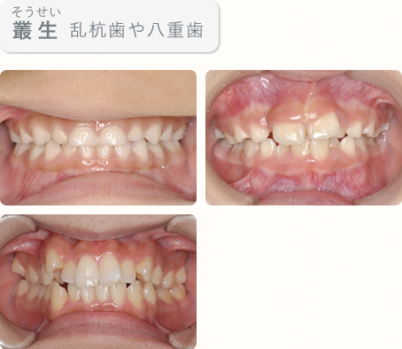 叢生(そうせい)　乱杭歯や八重歯