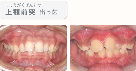 上顎前突(じょうがくぜんとつ)　出っ歯