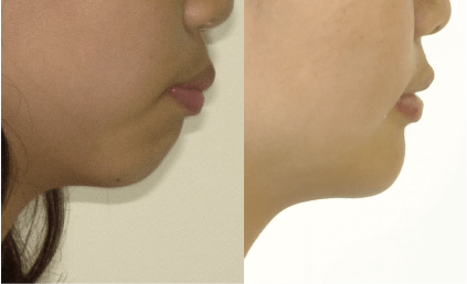 歯並びがよくても下唇が閉じにくかったり前歯が当たらない状態は大丈夫