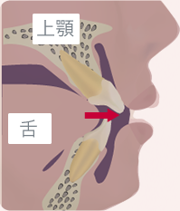 口呼吸の場合　イメージ