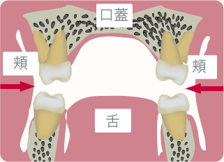 口呼吸の場合　イメージ