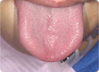 低位舌/舌の運動不良　イメージ