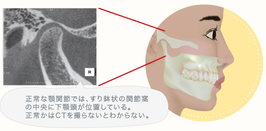 正常な顎関節では、すり鉢状の関節窩の中央に下顎頭が位置している。正常かはCTを撮らないとわからない。