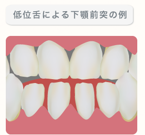 低位舌による下顎前突の例