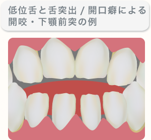 低位舌と舌突出/開口癖による開咬・下顎前突の例