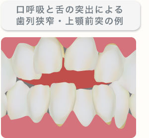 口呼吸と舌の突出による歯列狭窄・上顎前突の例