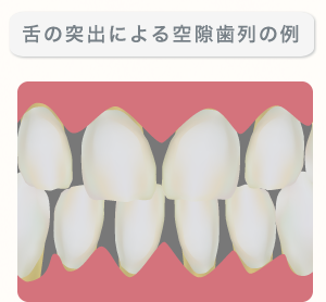 舌の突出による空隙歯列の例