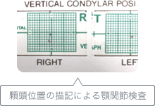 パナデント咬合器に模型を装着