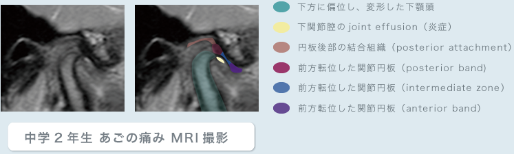 中学2年生 あごの痛み MRI撮影