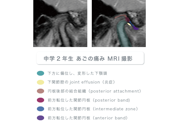 中学2年生 あごの痛み MRI撮影