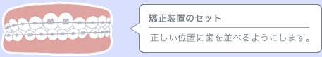 矯正装置のセット／正しい位置に歯を並べるようにします。