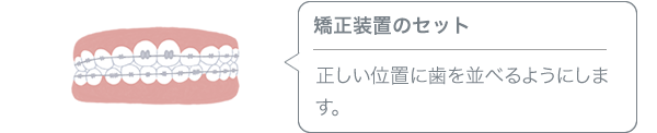 矯正装置のセット／正しい位置に歯を並べるようにします。