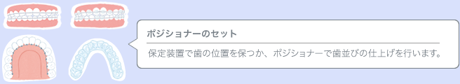 ポジショナーのセット／保定装置で歯の位置を保つか、ポジショナーで歯並びの仕上げを行います。