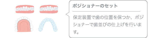 ポジショナーのセット／保定装置で歯の位置を保つか、ポジショナーで歯並びの仕上げを行います。