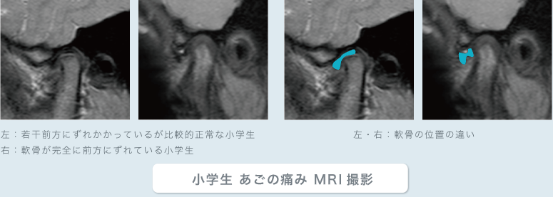小学生 あごの痛み MRI撮影