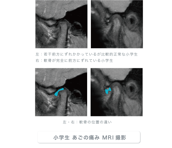 小学生 あごの痛み MRI撮影