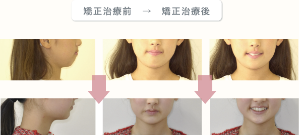 矯正治療前　→　矯正治療後