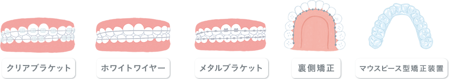 永久歯列に用いる矯正装置イメージ