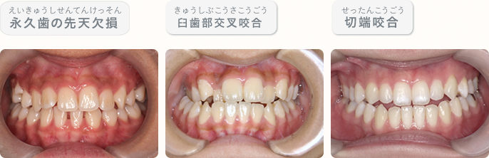 永久歯の先天欠損、、臼歯部交叉咬合、切端咬合