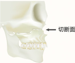 上顎:Le fort I型骨切り術