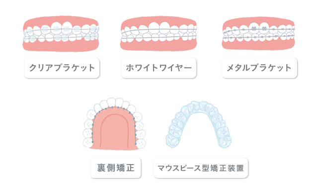 永久歯列に用いる矯正装置イメージ