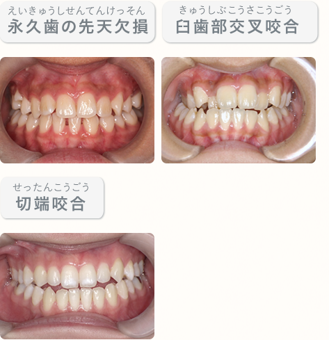 永久歯の先天欠損、、臼歯部交叉咬合、切端咬合